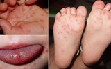 [ẢNH] Những loại bệnh dịch phổ biến do thời tiết ở Việt Nam